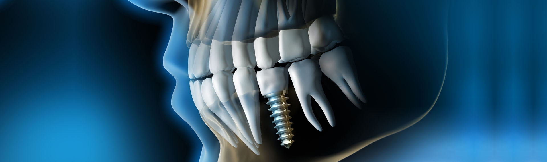 Implant Dentar Bacau